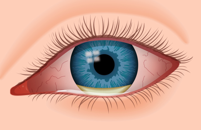 Øyesykdommer | eyedoctor